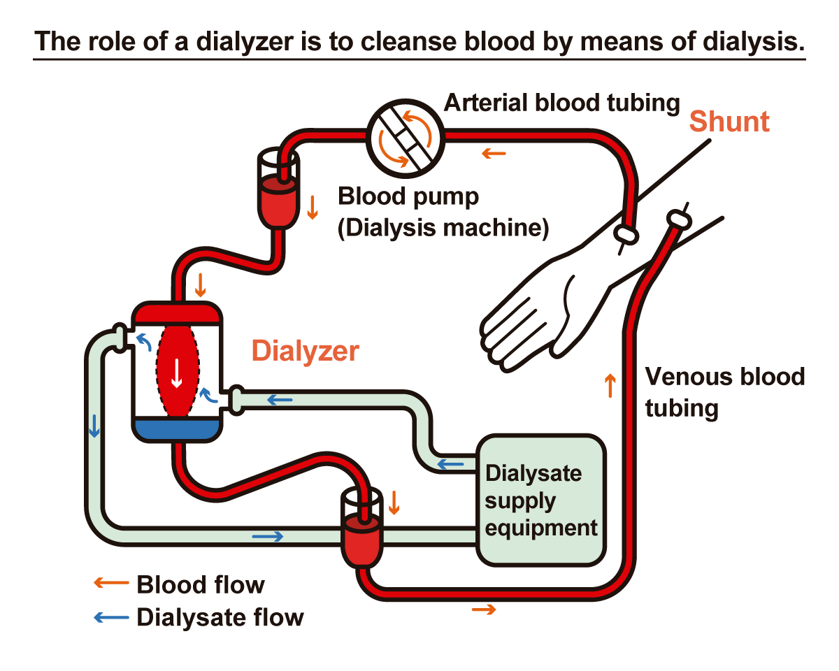 The role of a dialyzer is to cleanse blood by means of dialysis